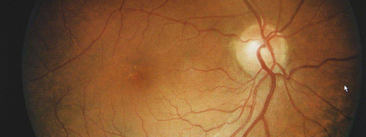 How to treat eye allergy, Eye Care in Washington, IA
